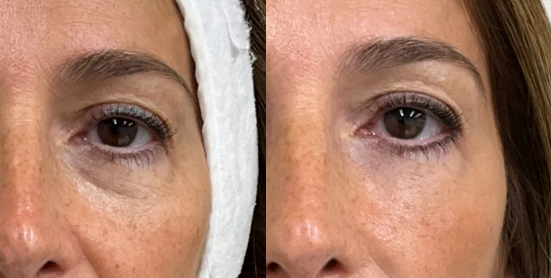 Dermapen Eyebooster